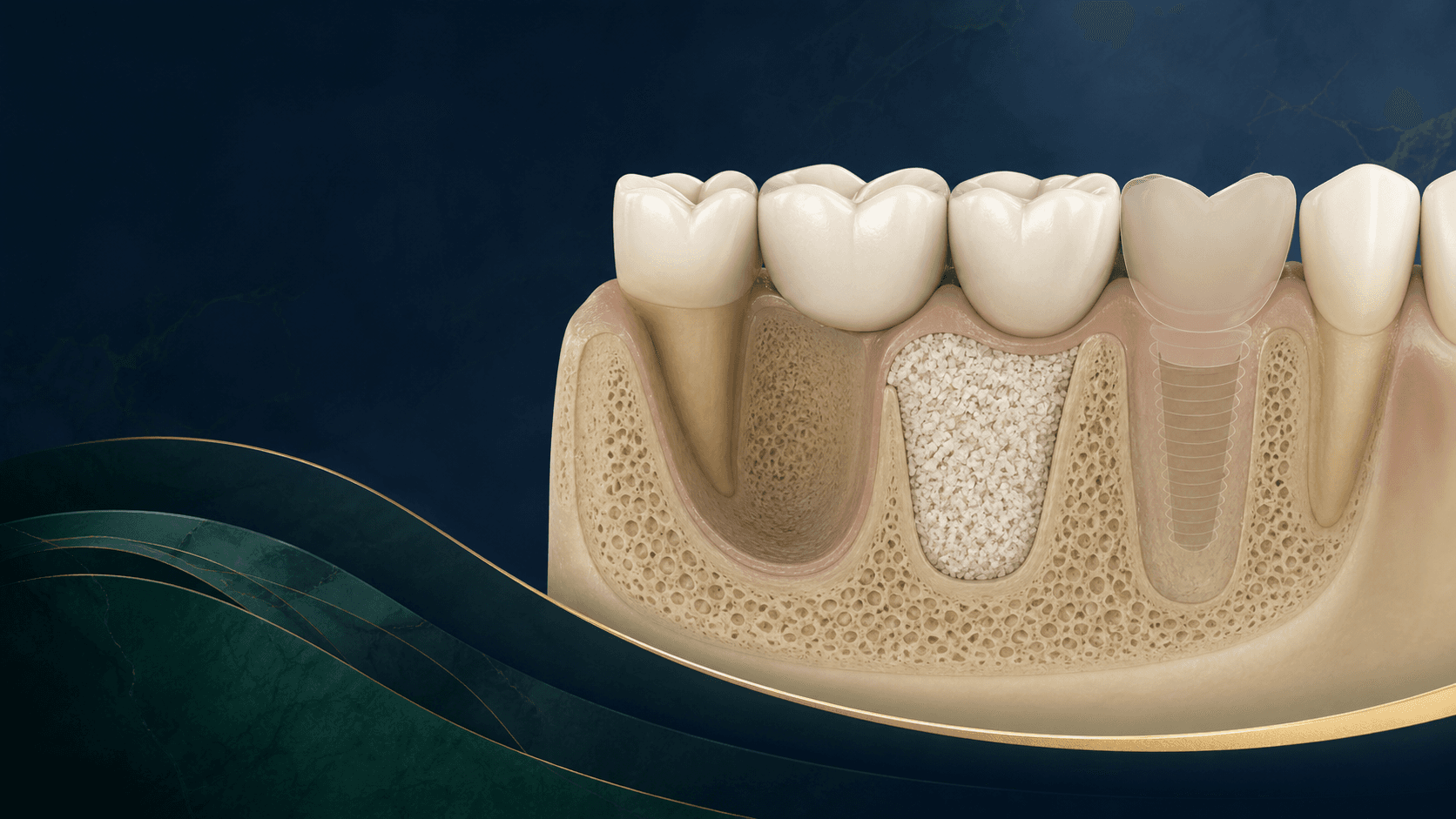 Illustration médicale d’une reconstruction osseuse avant la pose d’un implant dentaire